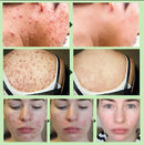 Creme Removedor de Espinhas™ - Limpeza Profunda Perfect Face