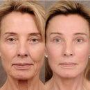 DermaWand® Pro Mesoterapia (Compre e Ganhe 1 Bolsa De Brinde)