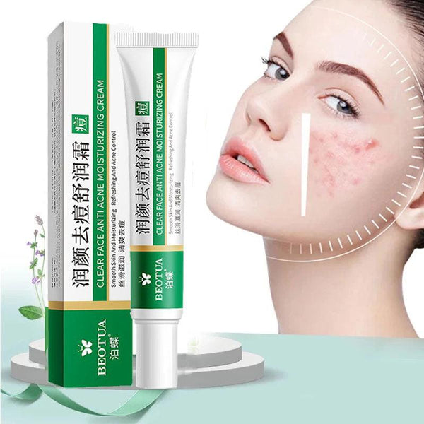 Creme Removedor de Espinhas™ - Limpeza Profunda Perfect Face
